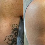 Фото удаление татуировки 21.11.2018 №025 - photo tattoo removal - tatufoto.com