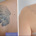 Фото удаление татуировки 21.11.2018 №028 - photo tattoo removal - tatufoto.com