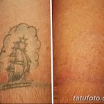 Фото удаление татуировки 21.11.2018 №030 - photo tattoo removal - tatufoto.com