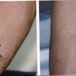 Фото удаление татуировки 21.11.2018 №034 - photo tattoo removal - tatufoto.com