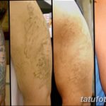 Фото удаление татуировки 21.11.2018 №038 - photo tattoo removal - tatufoto.com