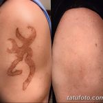 Фото удаление татуировки 21.11.2018 №043 - photo tattoo removal - tatufoto.com