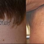 Фото удаление татуировки 21.11.2018 №044 - photo tattoo removal - tatufoto.com