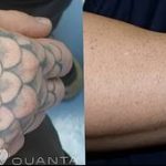 Фото удаление татуировки 21.11.2018 №047 - photo tattoo removal - tatufoto.com