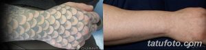 Фото тату чешуи до и после удаления. Демонстрирует процесс удаления татуировки с изображением чешуи дракона.