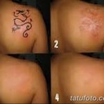 Фото удаление татуировки 21.11.2018 №051 - photo tattoo removal - tatufoto.com