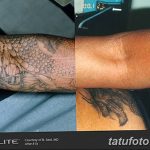 Фото удаление татуировки 21.11.2018 №052 - photo tattoo removal - tatufoto.com