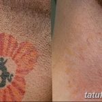 Фото удаление татуировки 21.11.2018 №053 - photo tattoo removal - tatufoto.com