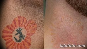 Фотография демонстрирует процесс удаления татуировки с изображением символа Ом на шее с помощью лазерной технологии. Сравнение состояния татуировки до и после процедуры.