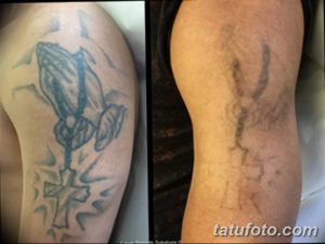 Фотография демонстрирует процесс удаления татуировки с изображением молящихся рук на руке с помощью лазерной технологии. Сравнение состояния татуировки до и после процедуры.