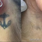 Фото удаление татуировки 21.11.2018 №055 - photo tattoo removal - tatufoto.com
