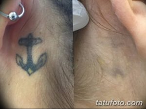 Фотография демонстрирует процесс удаления татуировки с изображением якоря на шее с помощью лазерной технологии. Сравнение состояния татуировки до и после процедуры.