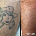 Фотография демонстрирует процесс удаления татуировки с изображением портрета женщины с помощью лазерной технологии. Сравнение состояния татуировки до и после процедуры.