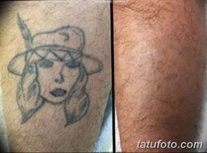 Фотография демонстрирует процесс удаления татуировки с изображением портрета женщины с помощью лазерной технологии. Сравнение состояния татуировки до и после процедуры.