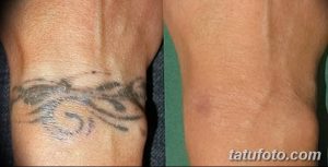 Фотография демонстрирует процесс удаления татуировки на запястье с помощью лазерной технологии. Сравнение состояния татуировки до и после процедуры.
