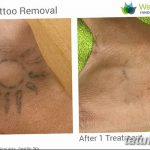 Фото удаление татуировки 21.11.2018 №059 - photo tattoo removal - tatufoto.com