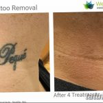 Фото удаление татуировки 21.11.2018 №060 - photo tattoo removal - tatufoto.com