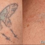 Фото удаление татуировки 21.11.2018 №064 - photo tattoo removal - tatufoto.com