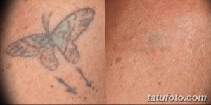 Фото тату до и после удаления: выцветшая татуировка бабочки на коже, демонстрирующая результаты лазерного удаления татуировки.