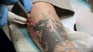 Фото процесса удаления татуировки лазером: рука мастера с лазерным аппаратом, направленным на татуировку на ноге пациента.