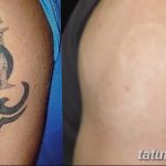 Фото удаление татуировки 21.11.2018 №066 - photo tattoo removal - tatufoto.com