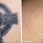 Фото удаление татуировки 21.11.2018 №067 - photo tattoo removal - tatufoto.com
