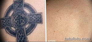Фото тату до и после удаления: выцветший кельтский крест на коже, демонстрирующий результаты лазерного удаления татуировки.