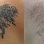 Фото удаление татуировки 21.11.2018 №070 - photo tattoo removal - tatufoto.com