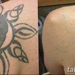 Фото удаление татуировки 21.11.2018 №071 - photo tattoo removal - tatufoto.com