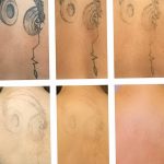 Фото удаление татуировки 21.11.2018 №072 - photo tattoo removal - tatufoto.com