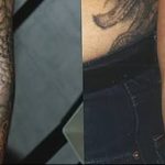 Фото удаление татуировки 21.11.2018 №073 - photo tattoo removal - tatufoto.com