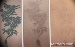 Фото тату: процесс удаления татуировки лазером, демонстрирующий этапы заживления и осветления рисунка после одного и двух сеансов.