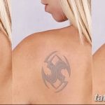 Фото удаление татуировки 21.11.2018 №077 - photo tattoo removal - tatufoto.com