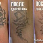 Фото удаление татуировки 21.11.2018 №080 - photo tattoo removal - tatufoto.com