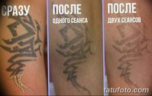 Фото тату: процесс удаления татуировки лазером, демонстрирующий этапы заживления и осветления рисунка после одного и двух сеансов.