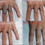 Фото удаление татуировки 21.11.2018 №083 - photo tattoo removal - tatufoto.com