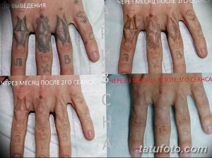 Фотография татуировок на пальцах рук до и после нескольких сеансов лазерного удаления. Видно осветление рисунков и восстановление кожи.