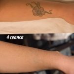 Фото удаление татуировки 21.11.2018 №084 - photo tattoo removal - tatufoto.com