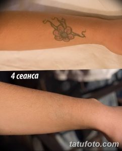 Фотография татуировки с изображением цветка на руке до и после нескольких сеансов лазерного удаления. Видно осветление рисунка.