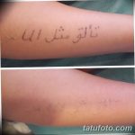 Фото удаление татуировки 21.11.2018 №087 - photo tattoo removal - tatufoto.com