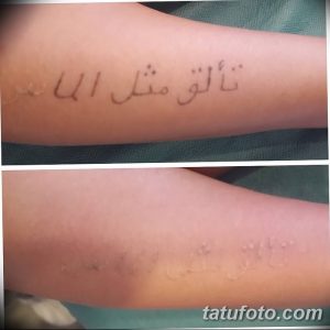 Фотография арабской татуировки на руке до и после лазерного удаления. Видно значительное осветление текста.