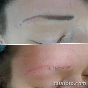 Фотография татуажа бровей до и после процедуры удаления лазером. Видно осветление пигмента и восстановление естественной формы бровей.