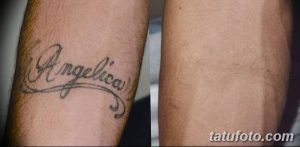 Фото татуировки с именем 'Angelica' на предплечье до и после процедуры удаления лазером. Виден процесс осветления рисунка.