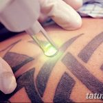 Фото удаление татуировки 21.11.2018 №092 - photo tattoo removal - tatufoto.com