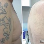 Фото удаление татуировки 21.11.2018 №095 - photo tattoo removal - tatufoto.com