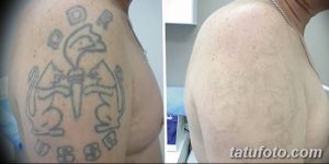 Фото старой татуировки с изображением кинжала и розы до и после лазерного удаления. Видны остатки рисунка и чистая кожа.