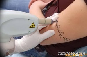 Фото процесса лазерного удаления татуировки на руке. Виден аппарат для удаления татуировок и кожа с начинающимися изменениями.