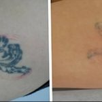 Фото удаление татуировки 21.11.2018 №100 - photo tattoo removal - tatufoto.com