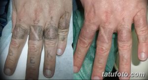 Фото тату на пальцах до и после удаления лазером. Видны остатки черного рисунка и чистая кожа после процедуры.