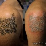 Фото удаление татуировки 21.11.2018 №102 - photo tattoo removal - tatufoto.com